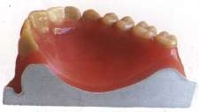 Beispiel für Polyan; wird hier als Zahnfleischimitat verwendet