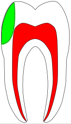 eine herkömmliche, wesentlich größere Füllung, die dichter an der Pulpa liegt