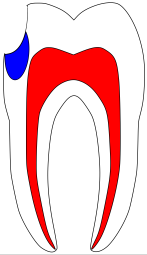 eröffnete und remineralisierte Karies